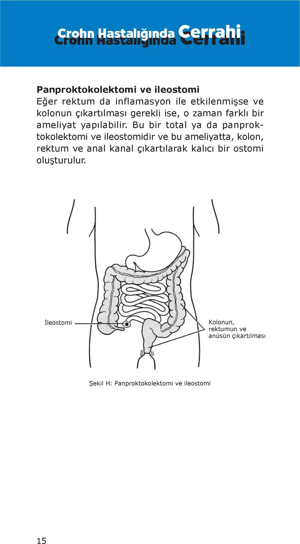 Bu bir total ya da panproktokolektomi ve ileostomidir ve bu ameliyatta, kolon, rektum ve anal kanal