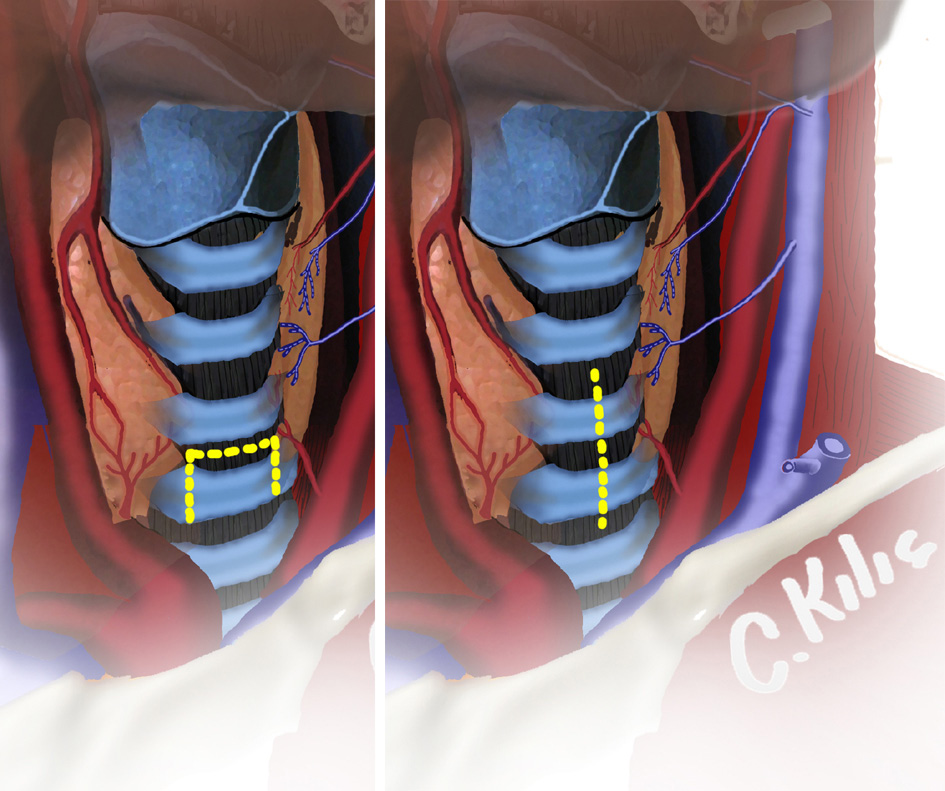 Şekil 2. Trakeaya uygulanan insizyonlar. Trakeostominin bakımı: - Trakeostomi kanülü güvenli bir şekilde sabitlenmeli ve 5-7 günde oluşacak kutano-endotrakeal yolun oluşması sağlanmalıdır.