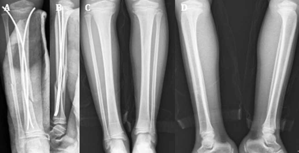 Çocuklarda araç dışı trafik kazası nedeniyle gelişen tibia şaft kırıklarının titanyum elastik çiviyle tedavisi Şekil 2: (A, B) Yüksek enerjili araç dışı trafik kazası nedeniyle grade II açık tibia