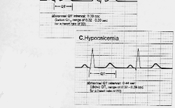 Hiperkalsemi Serum kalsiyum düzeyi 10.