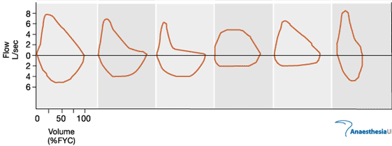 Akım-volüm halkasının şekli intratorasik/ekstratorasik solunum yolu darlıklarında, obstrüktif / restriktif hastalıklarda tipik