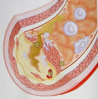 3). Tip IV lezyon genellikle yarım ay şeklindedir ve damar duvarı kalınlığını artırır. Bu evrede orjinal lümen çapını korumak için arterde yeniden yapılanma oluşur 43. Şekil 3.