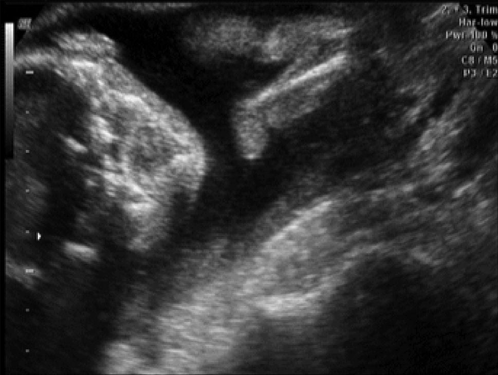 Tek tarafl ileri derecede fetal hidrotoraks olgusunda ekstrauterin intrapartum tedavi prosedürü ci er hipoplazisi nedeniyle intrauterin dönemde ölümle sonuçlanabilmektedir.
