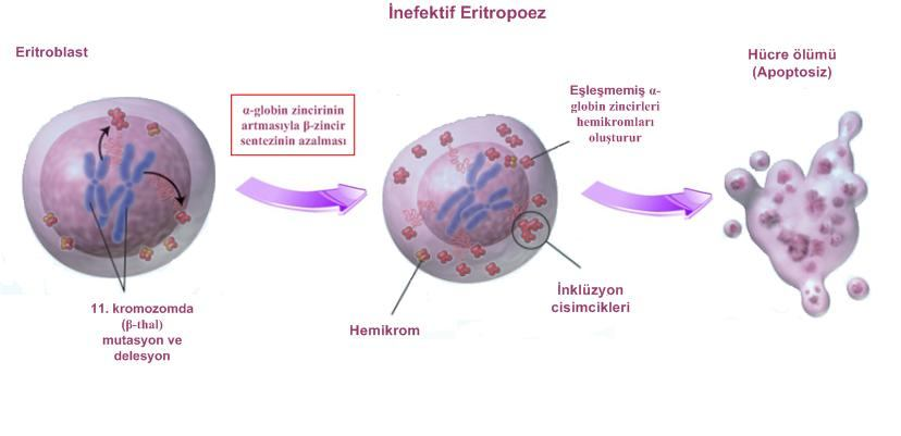 17 hücrelerinin intramedüller hasarlanmasına, anormal hücre olgunlaşmasına ve kemik iliğinde erken Hb yıkımına (inefektif eritropoez) yol açar (Şekil 1.14.) (Tuzmen ve ark., 2001; Efremov, 2007).