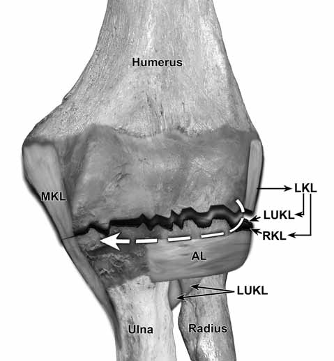 Dirsek eklemi anatomisi ve instabilitesi altından geçtiği posterior çıkıklardan, daha sık gözlenir.