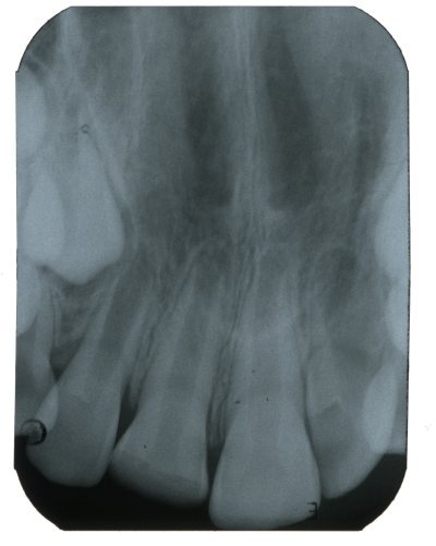 12-16 yaş grubu çocuklarda atletik performansın belirlenmesinde fiziki ve kardiyorespiratuar Pala özelliklerin K, Doğan S, etkisi Er Ö gözlenen dental travmaların çoğunluğu maksiller kesici dişlerde