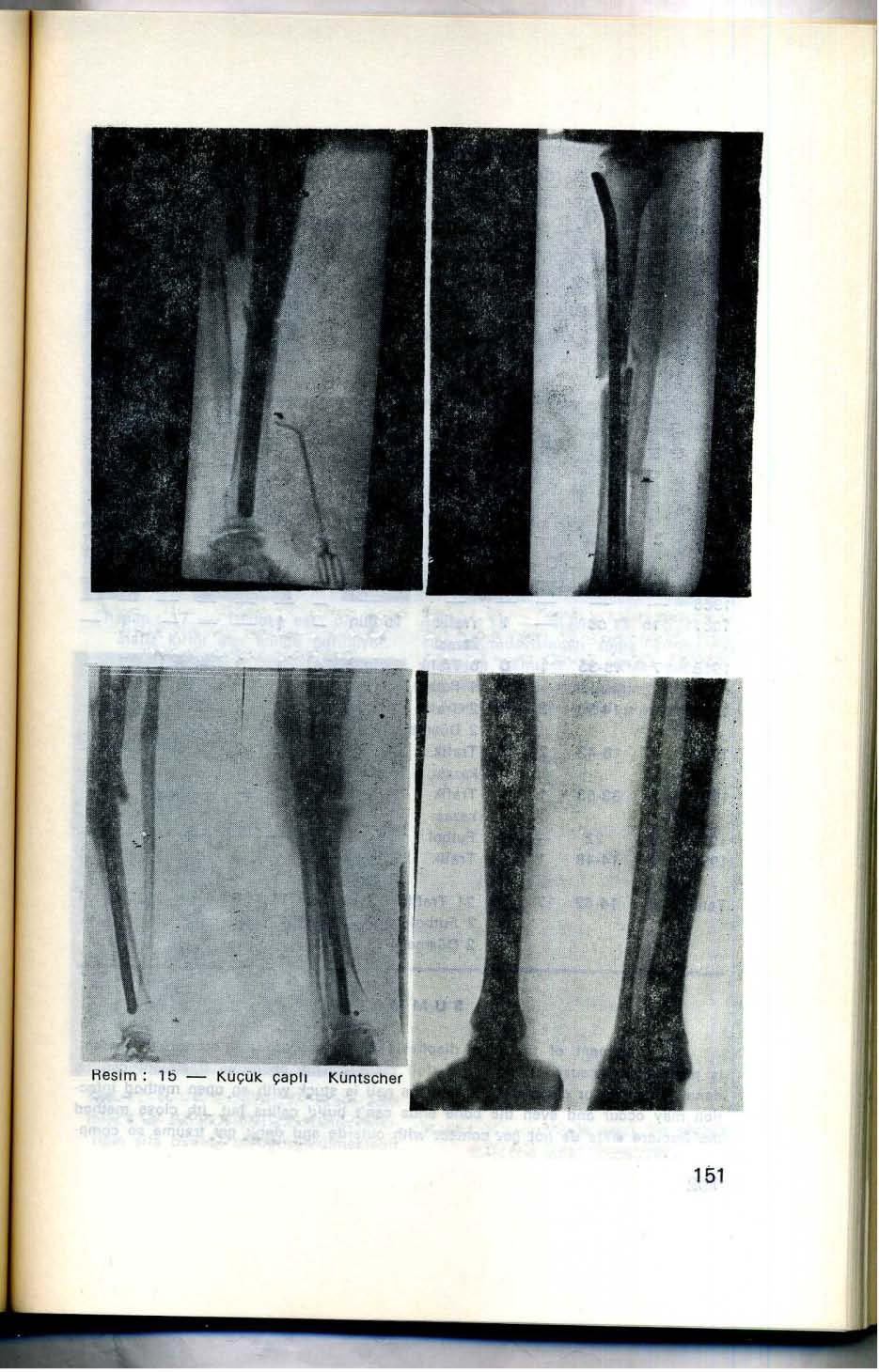 Resim: 13 - Çivinin alt ucunun eklem yüzüne 0,5 cm. yaklaşıncaya kadar çakılmış olduliu görülmekte. Resim :- 14 - Kemik kanalını doıcıurmayan küçük çaplı Küntscher çi isi.