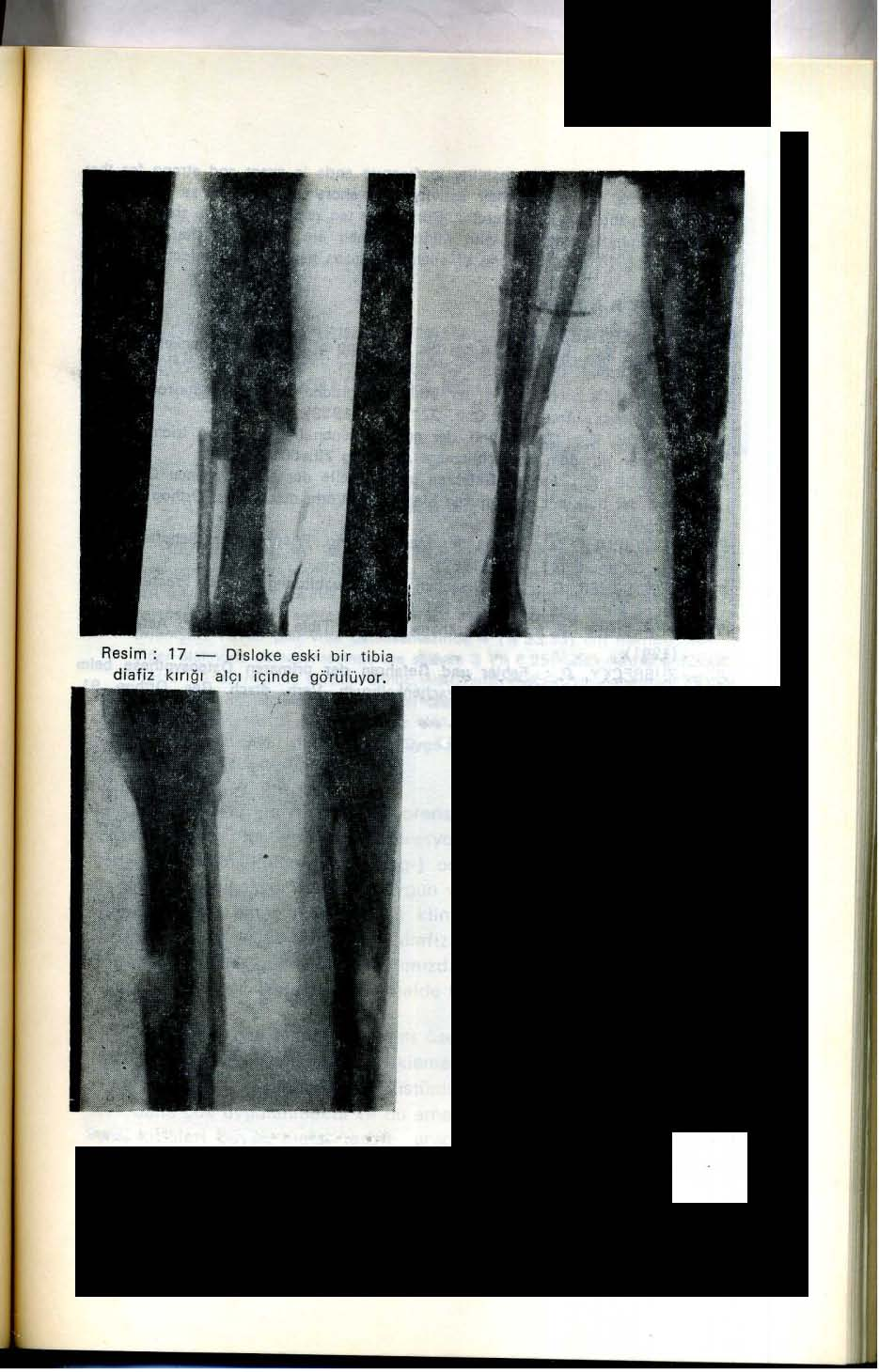 Resim: 18 - Resim 17 deki kırığın çivi ile tedavisinden sonra enfeksiyon meydana çıkmıştır.