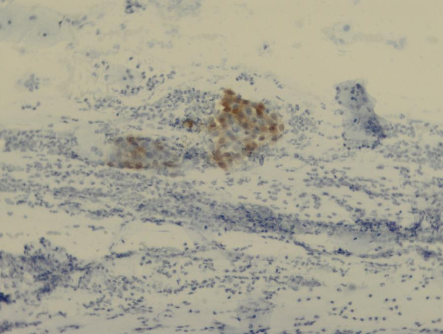 Resim 2: Nükleer ve sitoplazmik olarak p16 antikoru ile boyanmış bir hücre