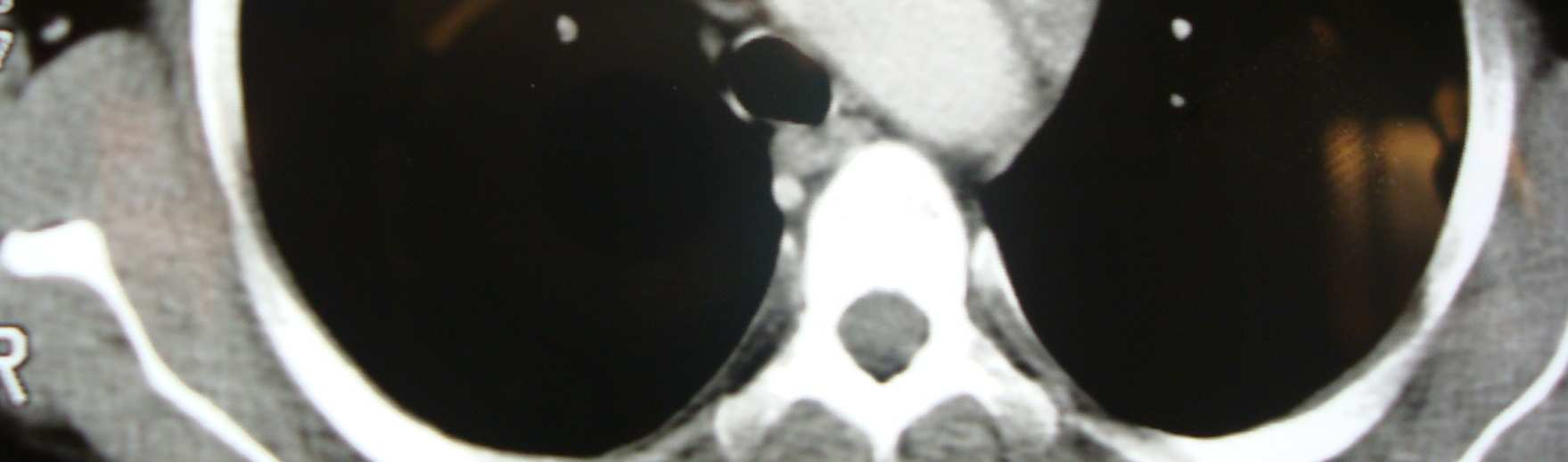 Şekil 7. Kocherin kolye kesisi ile başlanıp operasyona median sternotomi eklenen olgunun bilgisayarlı tomografi görüntüleri Şekil 8.