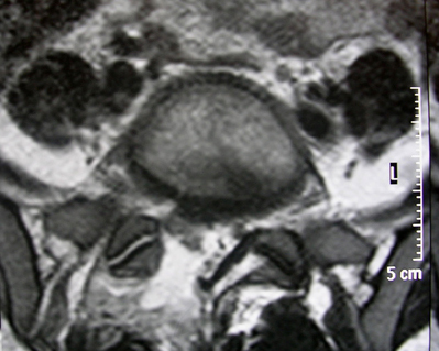 Şekil 3: L5-S1 disk mesafesinden geçen, T2 ağırlıklı aksiyel kesitlerde, sağ anterior epidural mesafede S1 kök basısı yapan, disk ile devamlılık gösteren kitle görüldü.