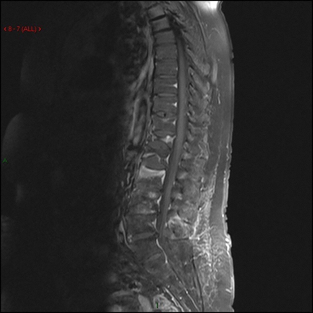 Osteoporoz multipl