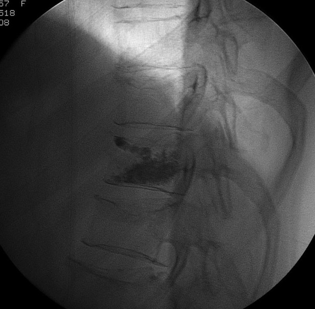 Vertebroplasti %24.