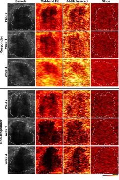 Kantitatif ultrason spektral texture Meme kanseri Sensitivite