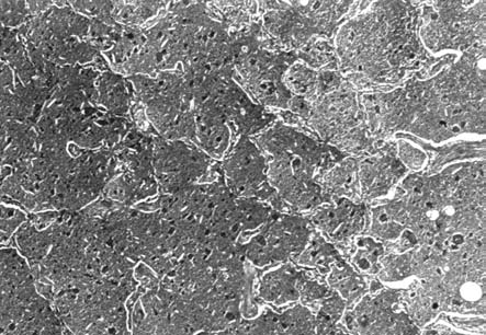 Pulmoner Alveoler Proteinozis (Olgu Sunumu) Resim 4. İntraalveoler eozinofilik bloblar ve interalveoler septumlarda Tip II hücre hiperplazisi (HE, x200). Resim 2,3.