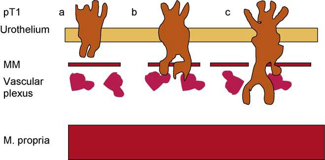 T1 subgruplaması Muskularis mukoza (MM) ve vasküler plexus (VP)