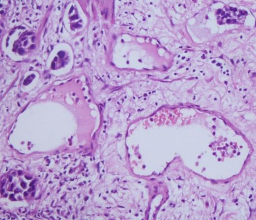 LVI (+) liğinin klinik önemi nedir? 1. Lotan et al. Lenf nodu negatif hastalarda LVİ prognozu etkilediğini 2.