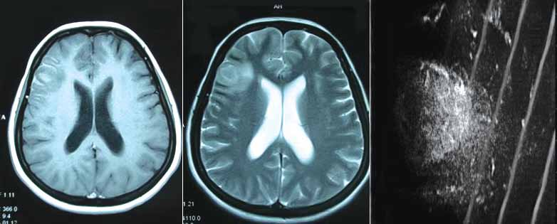 Şekil 4: Sağ frontal glial tümör nedeniyle opere edilen 36 yaşındaki hastanın T1 aksiyel MR (A), T2 aksiyel MR (B) ve intraoperatif ultrasonografi (C) görüntüsü. KAYNAKLAR 1.