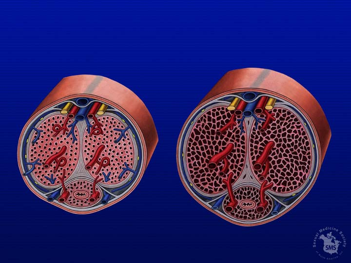 Penis anatomisi:enine Kesit Dorsal nerve Corpora cavernosa Dorsal vein Dorsal artery Tunica albuginea Corpus spongiosum Flaccid