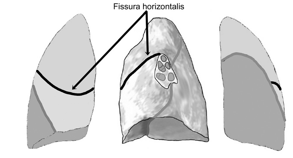 12 Pulmo sinister (sol akciğer) Fissura