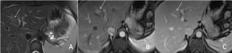 tümoral akım spektral analizinde arteriel akım patterni izlenmesi venöz akım gösteren hepatoselüler adenomdan ayırt etmek için bir bulgudur (39).