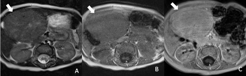 Ayırıcı tanı: Kontrastlı çalışmalarda arteriel fazda hiperattenue görünümde FNH, hepatoselüler karsinom ve fibrolameller karsinomu içeren diğer hiperattenue lezyonlar ayırıcı tanıda bulundurulmalıdır.