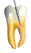 K-File Kanal girişlerinin bulunabilmesi için endodontik kavite kanal ağızlarının konumuna uygun bir şekilde açılmalıdır.