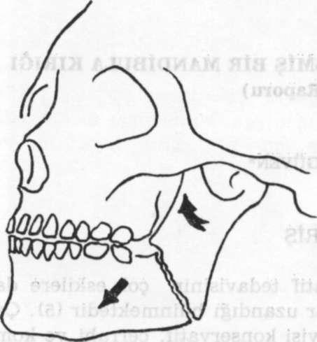 MANDİBULA KIRIĞI Şekil 1. Bazı özel durumlarda örneğin mandibulanın ramus kırıklarında kırık hattı iki kuvvetli kas kitlesi arasında kaldığından, hiç veya çok az bir deplasman gösterir.
