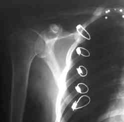 Supraspinatus infraspinatus ve subskapularis skapula medial kenar ndan 2.5-3 cm kalacak flekilde subperiostal olarak s yr ld.