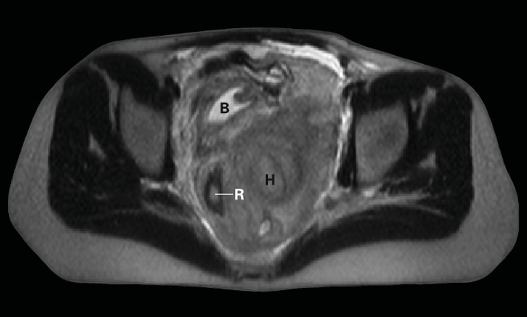 Pelvisin T2 ağırlıklı MRG si koronal (a) ve aksiyel (b) kesitler. Sol pelviste hematom (H) saptanmıştır. Pelvisin sağ tarafı korunmuştur. (R) Rektum ve komşu doku, (B) mesane.