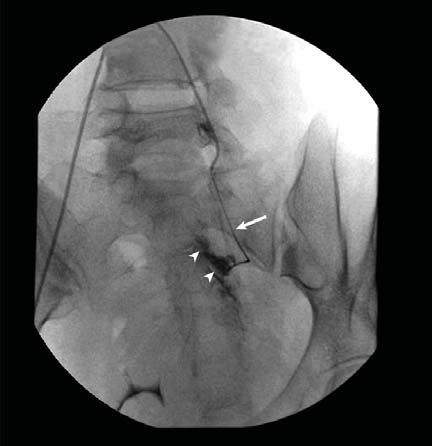 Hematomun uterus içinde ya da dışında olduğu ve pelvis yapısı ile ilişkisinin belirlenmesi ile embolizasyon yolu belirlenir (Şekil 2a ve b).