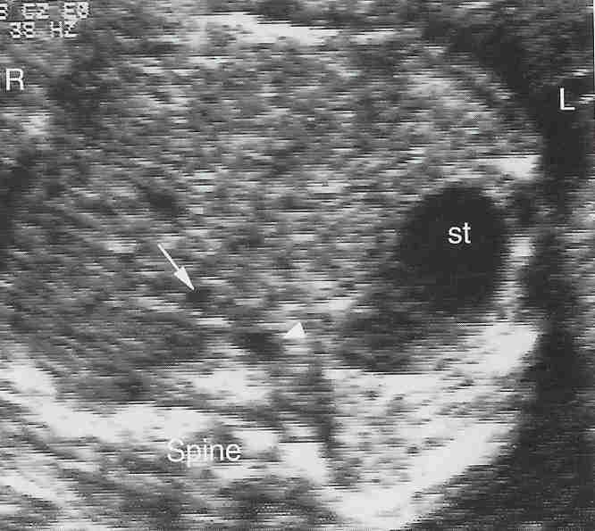 Başlangıç Fetal kalp pozisyonu - Mide ve kalp fetusun aynı bölümündedir - Mide hemen daima sıvı ile doludur - Mide görülmez veya küçükse kromozom anomalisi trakeo-ozöfageal fistül -Mide