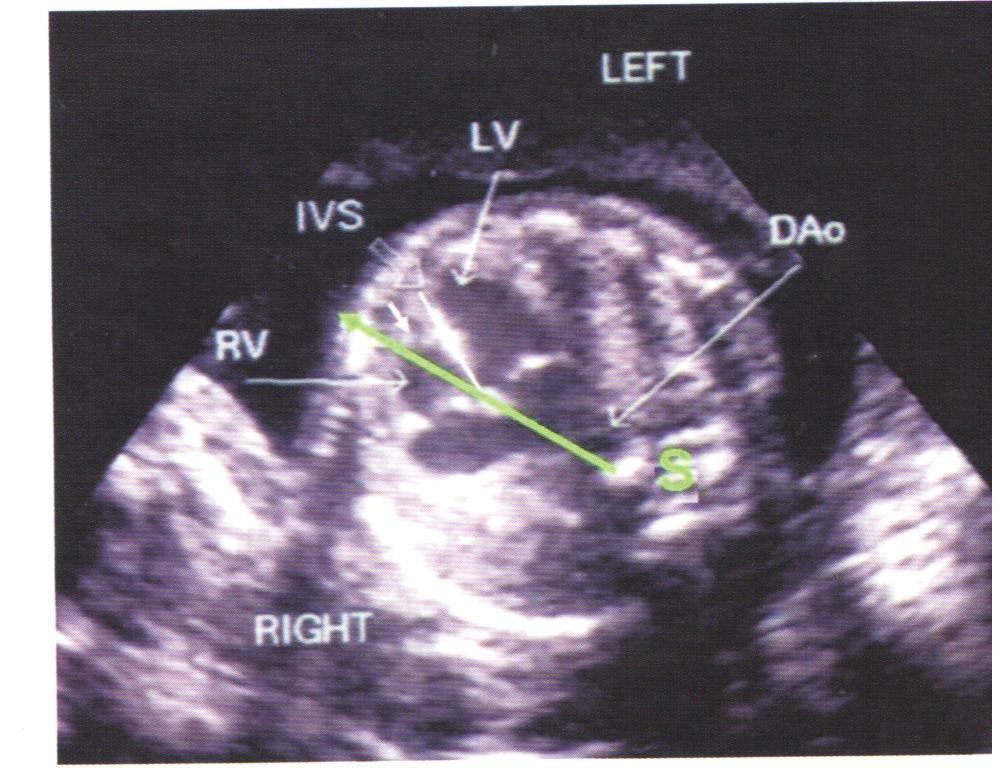 Fetal Kalp Pozisyonu -Kalbin torakstaki pozisyonu (levokardi, dekstrokardi, mezokardi)
