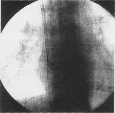 Trerotola OS, Scheel PJ, Zibari GB, Mcdonald JC. Hemodialysis access management. In: Trerotola OS and Savader JS. Venous Interventional Radiology with Clinical perspectives. New York, Thieme. 1996. 2.