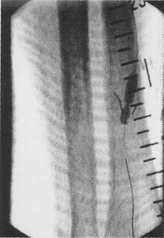 Resim 3 c: PTA sonrası kontrol anjiogramda, stenotik venöz