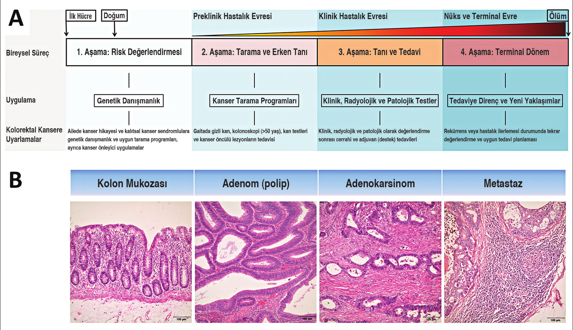 Resim 3. A. Birey odaklı yaşamsal süreç, tıbbi uygulamalar ve kolorektal kansere uyarlamalar. B. Normal kolon mukozasından adenom-karsinom gelişimi ve lenf nodu metastazı.