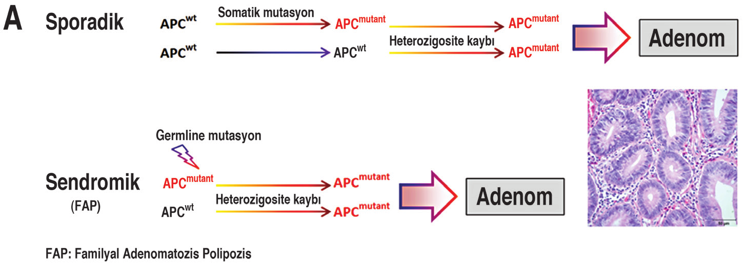 b. Serrated [mikrosatellit instabil-msi veya DNA hatalı eşleşme (mismatch) tamir mekanizması bozukluğu içeren (dmmr) grup] yolak, sendromik formu; Herediter Non-Polipozis Koli Kanser (HNPKK, Lynch)