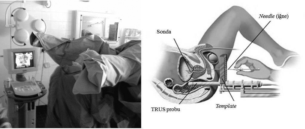 tirilir. Hasta pozisyonu, template ve TRUS probunun konumu Şekil 1 de gösterilmektedir. Eğer CTV ye dahil edilecek ise bu görüntüler seminal vezikülleri de içermelidir.