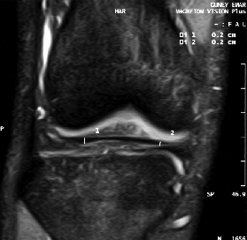 ARTROPLASTÝ ARTROSKOPÝK CERRAHÝ / JOURNAL OF ARTHROPLASTY & ARTHROSCOPIC SURGERY 131 131 Tablo I Ýntermeniskal Ligament Bulunma Sýklýðý ve Cinslere Göre Daðýlýmý Ýntermeniskal Ligament Var Yok Toplam