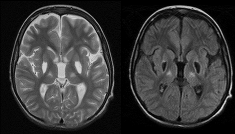 santral derin tip Lateral