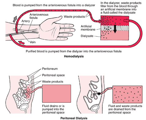 Periton dializi Arterovenöz Arter fistul Ven Atık ürünleri
