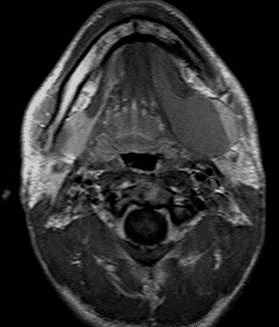 Dermoid kist Epidermoid