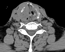 renal hücreli karsinom