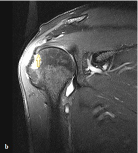 3 olguyu ise tendinosis olarak değerlendirmiştir. Ultrasonografinin parsiyel yırtık olarak değerlendirdiği 1 olgu MR incelemede tam kat yırtık tanısı almıştır.