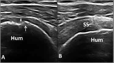 Spor Hekimliğinde Ultrasonografi Tendonda daha belirgin defektler parsiyel rüptürleri düşündürürken, tendonun görüntülenememesi ve tendon uçlarında retraksiyon, tam yırtığı akla getirir (Şekil 4).