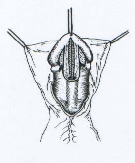 (a: Üretral plak lateral