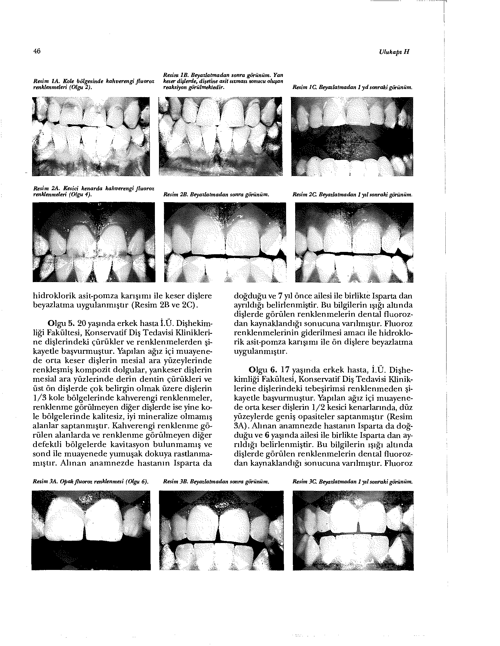 46 UlukapıH Resİnt 1B. Beyazlatmadan sonra görünüm. Yan Resim IA. Kale bölgesinde kahverengi fluoroz keser dişlerde, diyetine asit atması sonucu oluşan renklenmeleri (Olgu 2). reaksiyon görülmektedir.