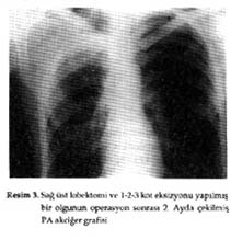 Tanı için materyal, bir olguda bronkoskopik biopsi ile, bir olguda postbronkoskopik balgam ile, 6 olguda da TTİB ile alındı.