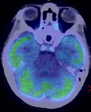 PET-CT