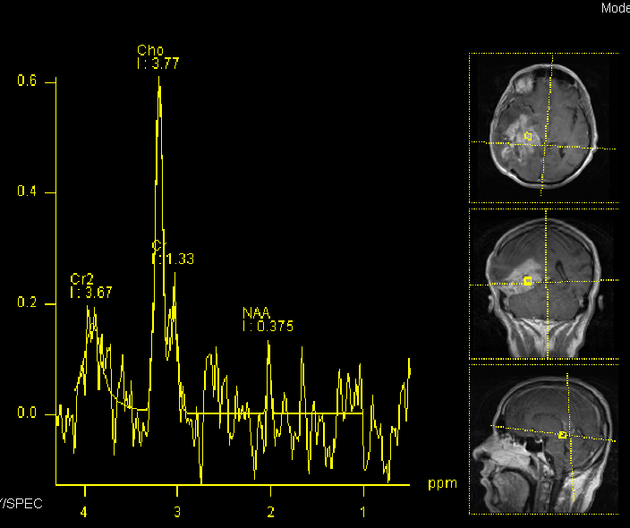 MRI MRS